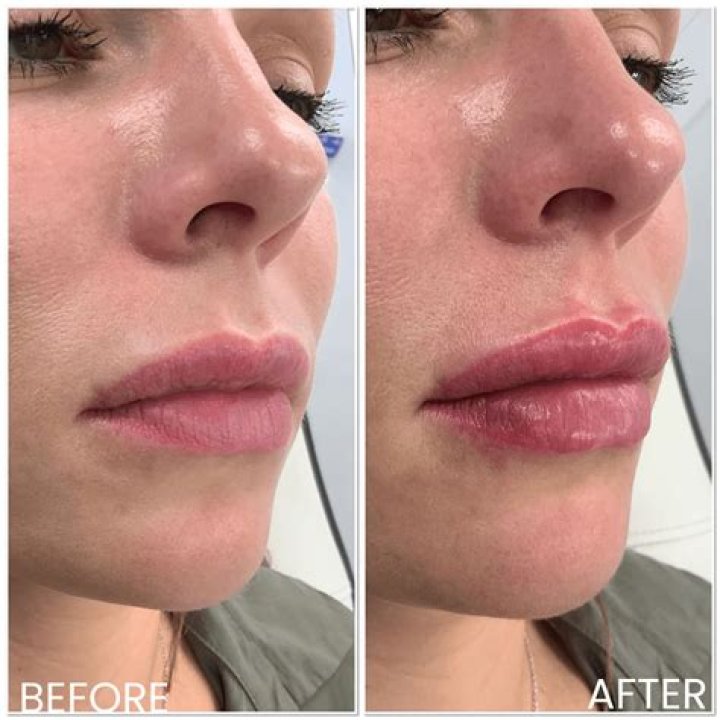 Jennifer Coolidge Botox And Lip Filler – Before And After Photos, Beauty Secret Explored!